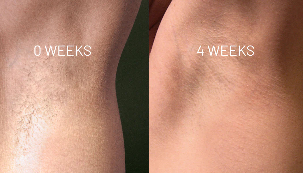 Hair Removal Oil