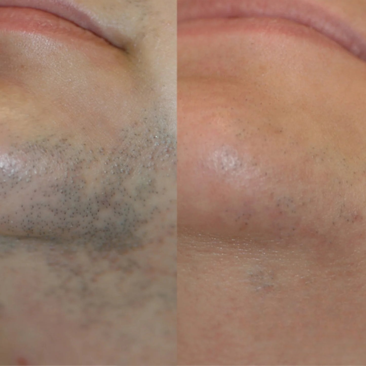 Hair Removal Oil