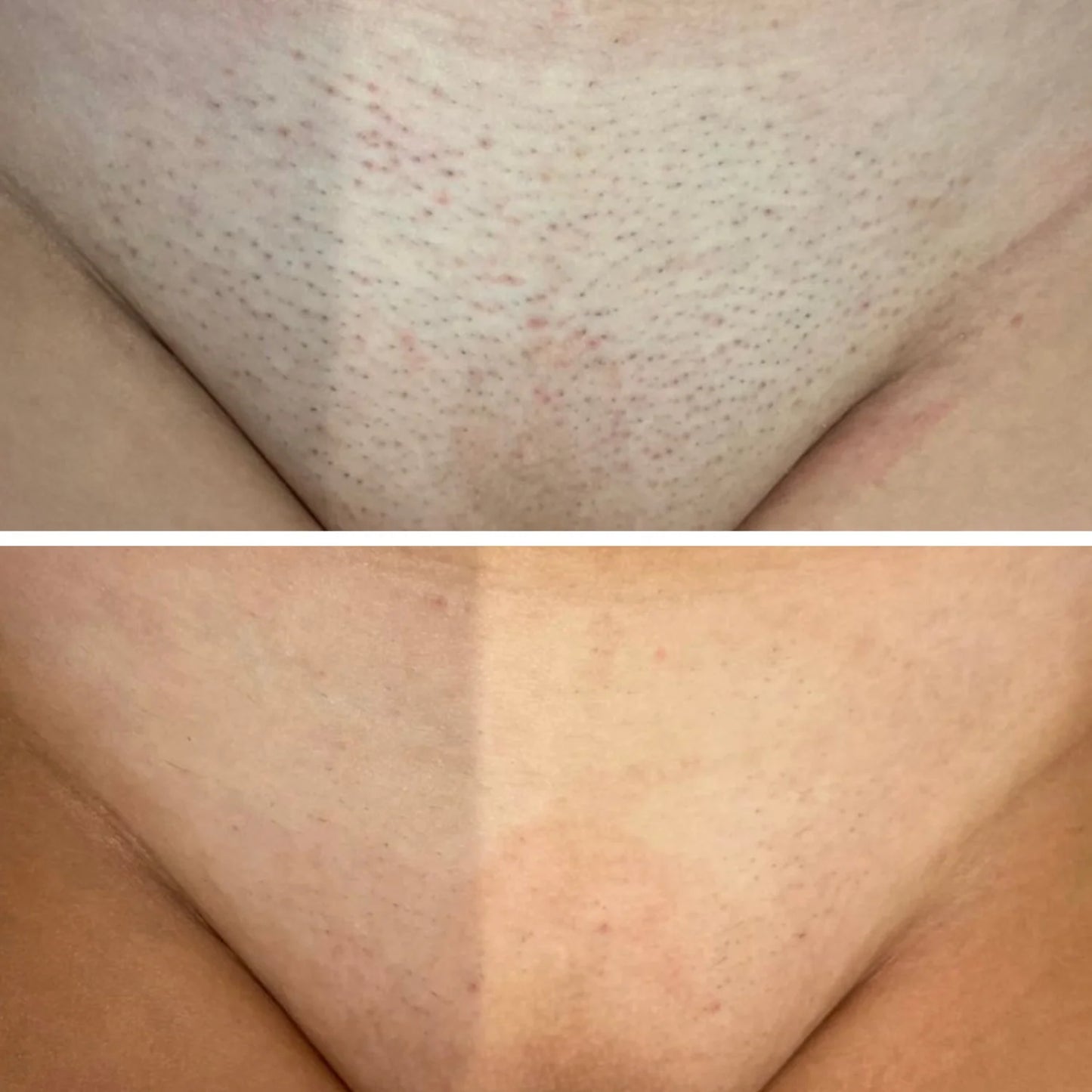 Hair Removal Oil