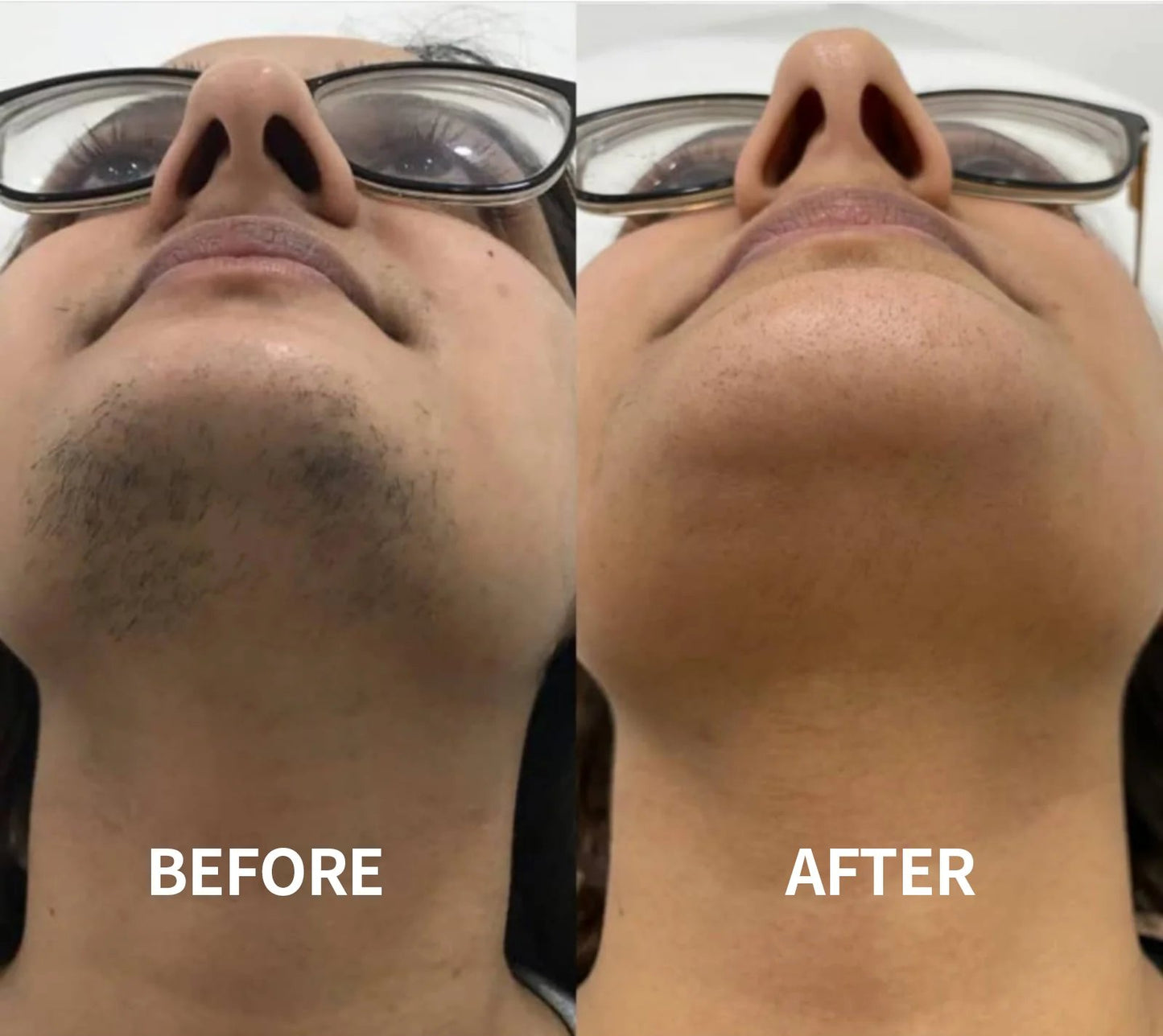 Gentle and Painless Facial Hair Removal Cream