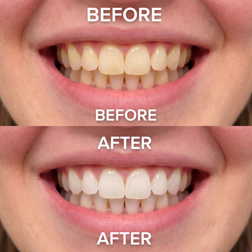 Purple Teeth Whitening Strips - 14 strips