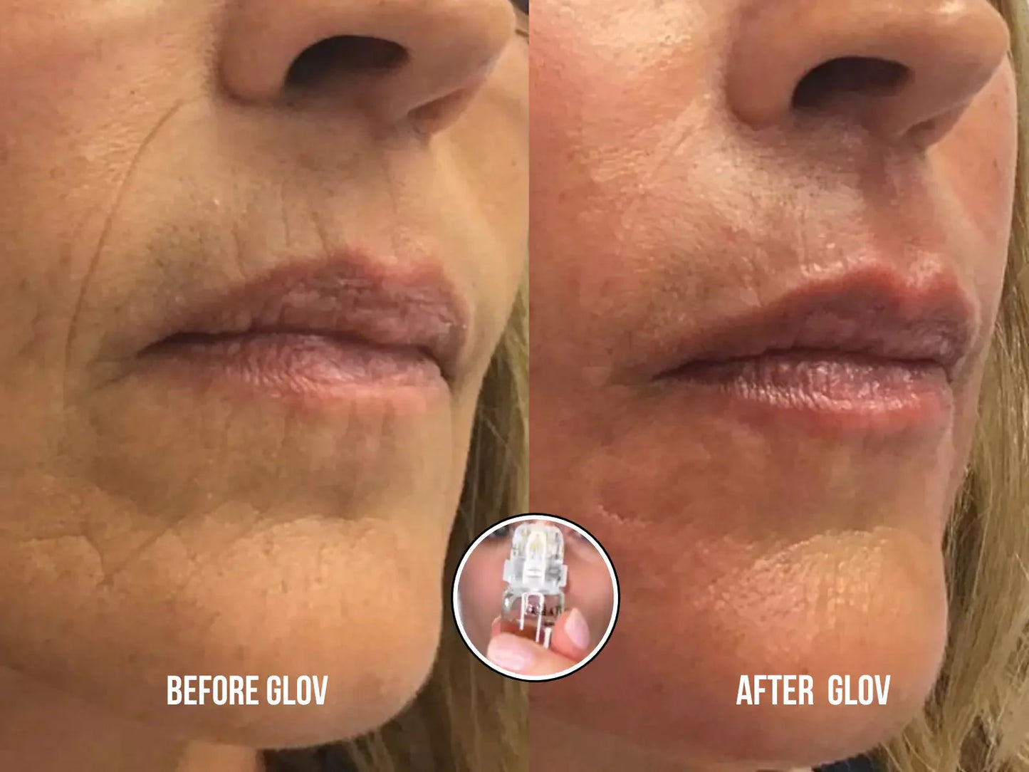 Glov Micro Infusion System