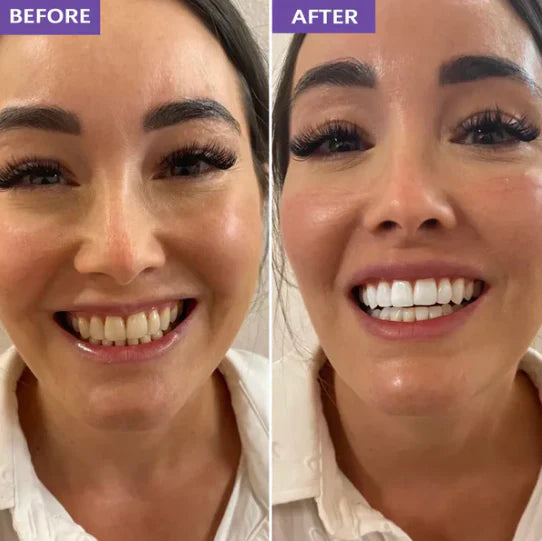 Purple Teeth Whitening Strips - 14 strips