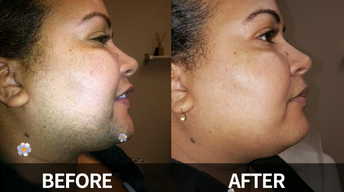 Gentle and Painless Facial Hair Removal Cream