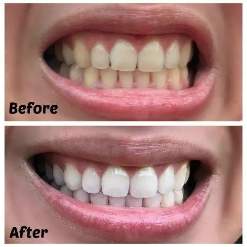 Purple Teeth Whitening Strips - 14 strips