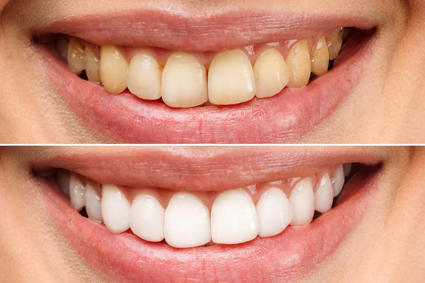 Purple Teeth Whitening Strips - 14 strips