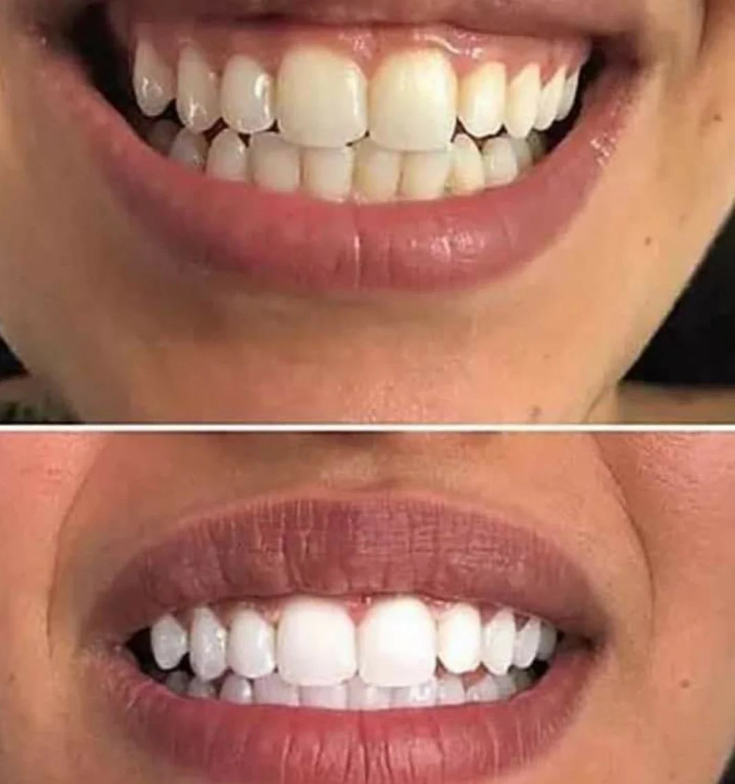 Purple Teeth Whitening Strips - 14 strips
